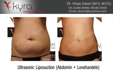 LIPOSUCTION FEMALE