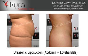 LIPOSUCTION FEMALE