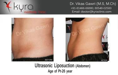 LIPOSUCTION FEMALE
