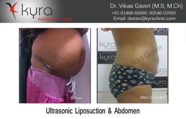 LIPOSUCTION FEMALE