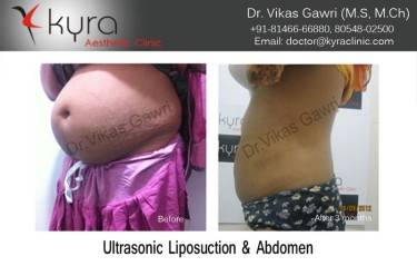 LIPOSUCTION FEMALE