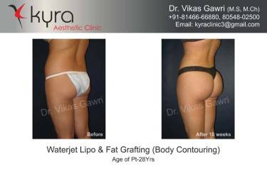 LIPOSUCTION FEMALE