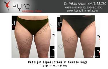 LIPOSUCTION FEMALE