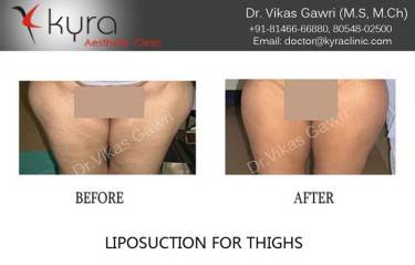 LIPOSUCTION FEMALE