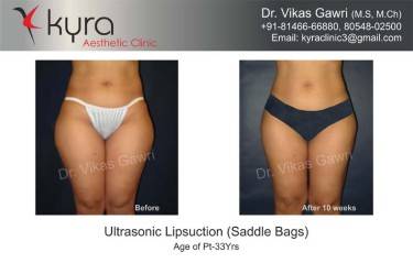 LIPOSUCTION FEMALE