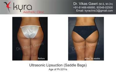 LIPOSUCTION FEMALE