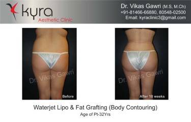 LIPOSUCTION FEMALE
