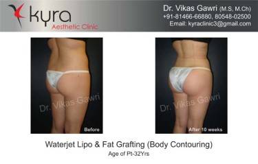 LIPOSUCTION FEMALE