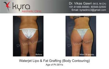 LIPOSUCTION FEMALE