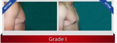 Gynaecomastia