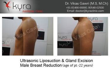 LIPOSUCTION MALE
