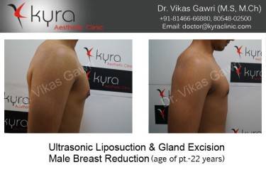 LIPOSUCTION MALE