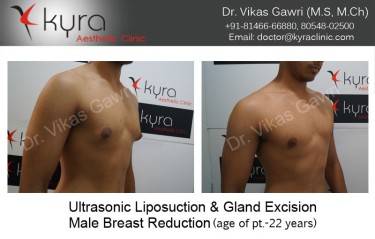 LIPOSUCTION MALE
