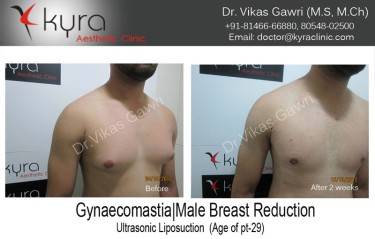 LIPOSUCTION MALE