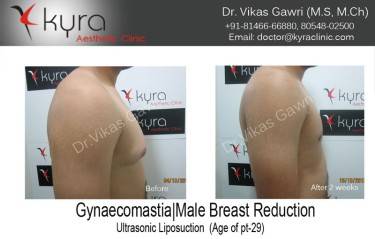 LIPOSUCTION MALE
