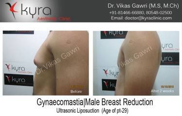 LIPOSUCTION MALE