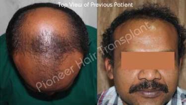 HAIR TRANSPLANT