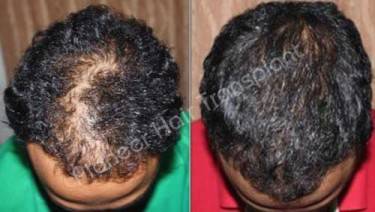 HAIR TRANSPLANT