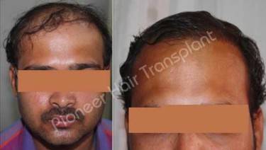 HAIR TRANSPLANT