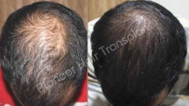 HAIR TRANSPLANT