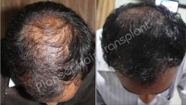HAIR TRANSPLANT