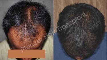HAIR TRANSPLANT