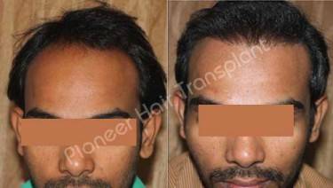 HAIR TRANSPLANT