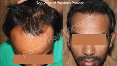 HAIR TRANSPLANT