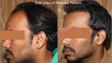 HAIR TRANSPLANT