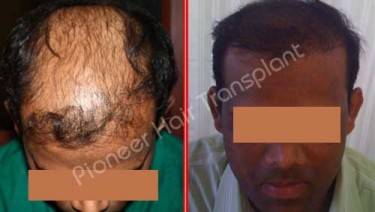 HAIR TRANSPLANT