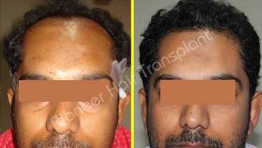 HAIR TRANSPLANT