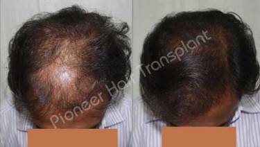 HAIR TRANSPLANT