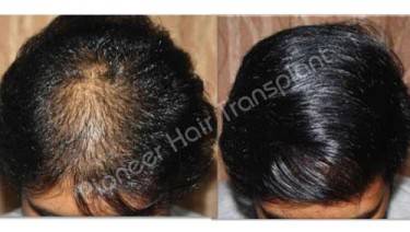 HAIR TRANSPLANT
