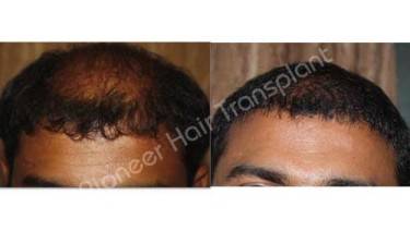 HAIR TRANSPLANT