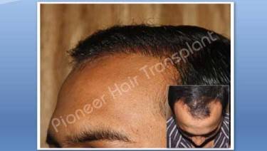 HAIR TRANSPLANT