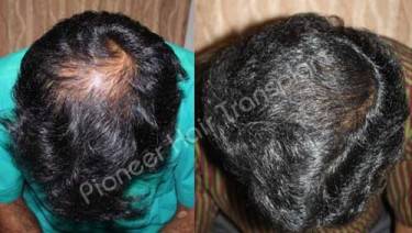 HAIR TRANSPLANT