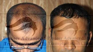 HAIR TRANSPLANT