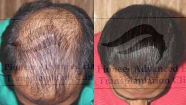 HAIR TRANSPLANT