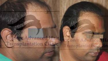 HAIR TRANSPLANT