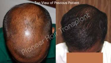 HAIR TRANSPLANT