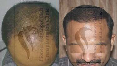 HAIR TRANSPLANT