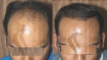 HAIR TRANSPLANT