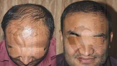 HAIR TRANSPLANT