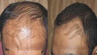 HAIR TRANSPLANT
