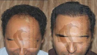 HAIR TRANSPLANT