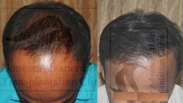 HAIR TRANSPLANT