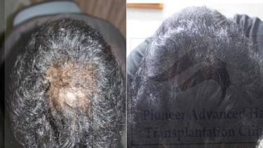 HAIR TRANSPLANT