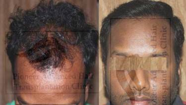 HAIR TRANSPLANT