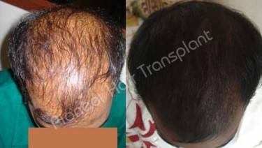 HAIR TRANSPLANT