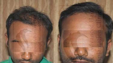 HAIR TRANSPLANT
